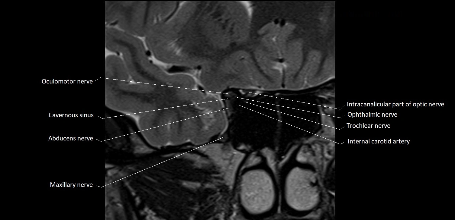MRI Orbit coronal cross sectional anatomy image 18.webp
